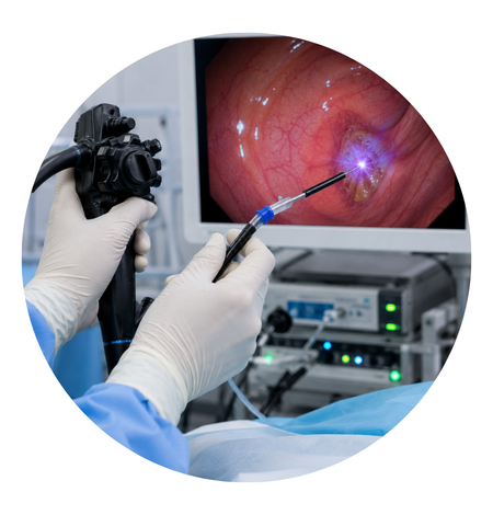 Argon Plasma Coagulation